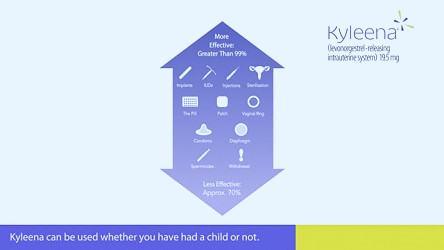 How Kyleena® IUD Works | Official Patient Site